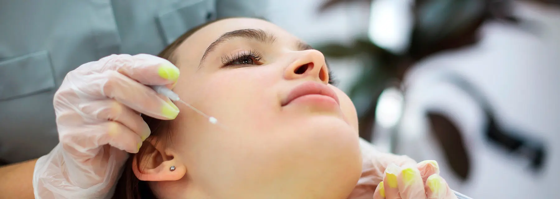 ¿Qué son los hilos PDO monofilamento?