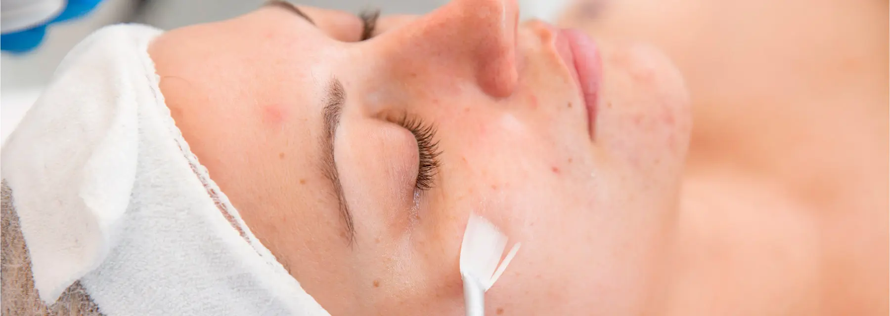 ¿Qué es el peeling químico médico y qué tipos hay?