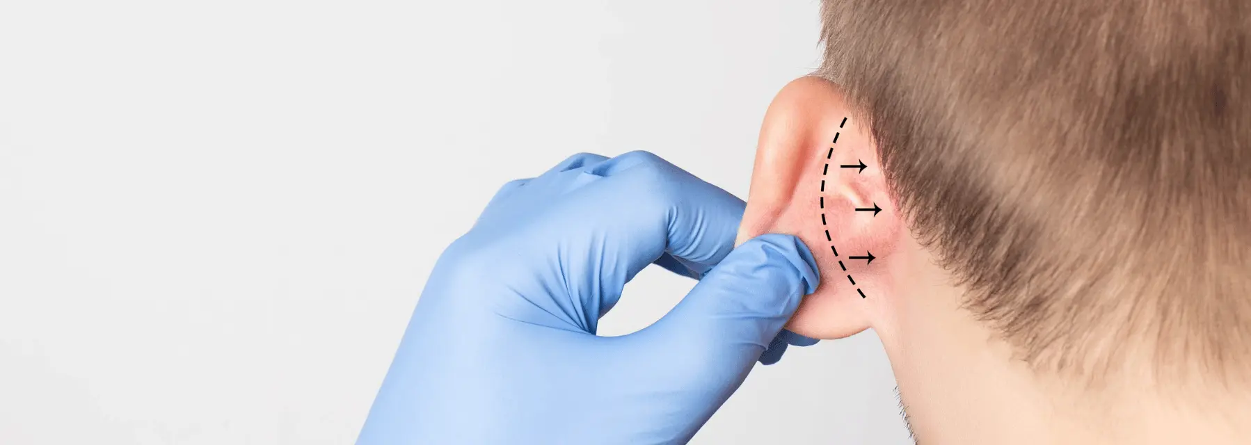 Operación de orejas: ¿en qué consiste?