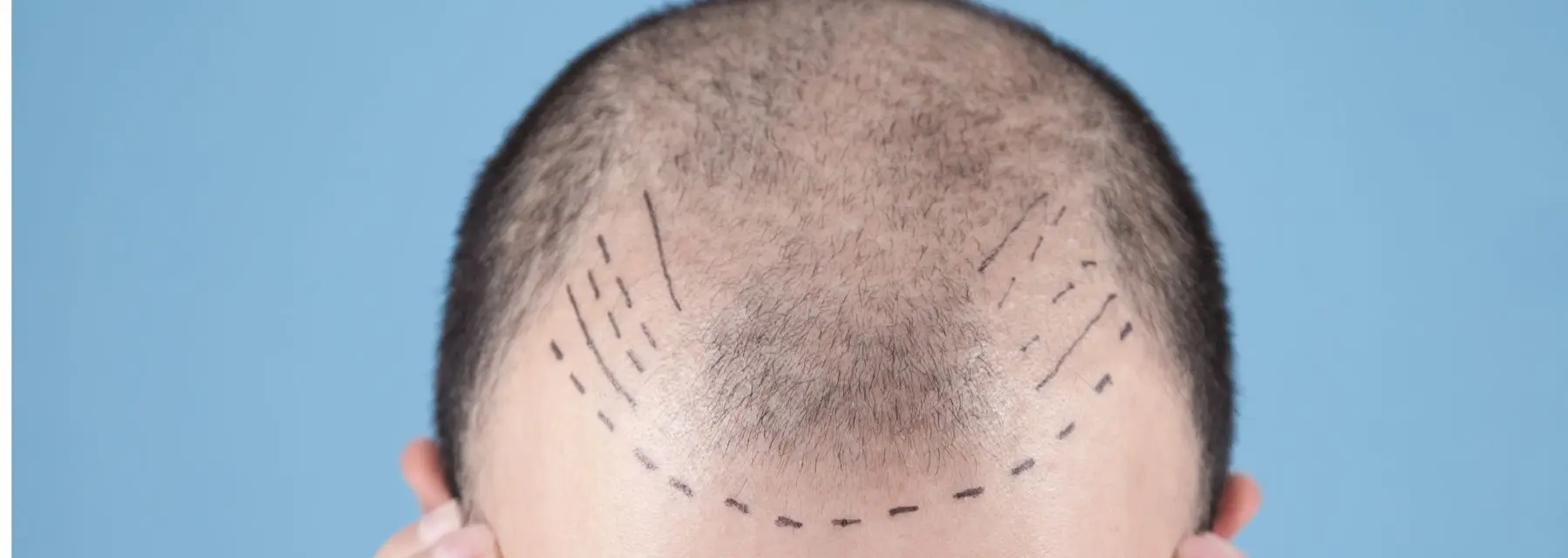 ¿Qué tipos de alopecia existen?
