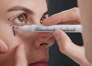 Blefaroplastia: ¿qué es?