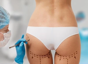¿Cómo se hace una lipotransferencia a glúteo?
